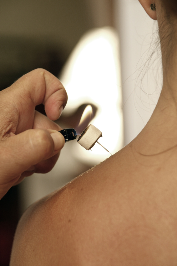 moxibustion